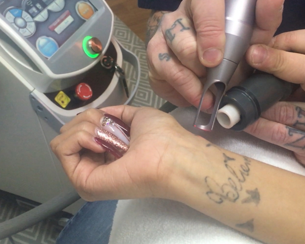 2019 – 2020 Outlook for Laser Tattoo Removal