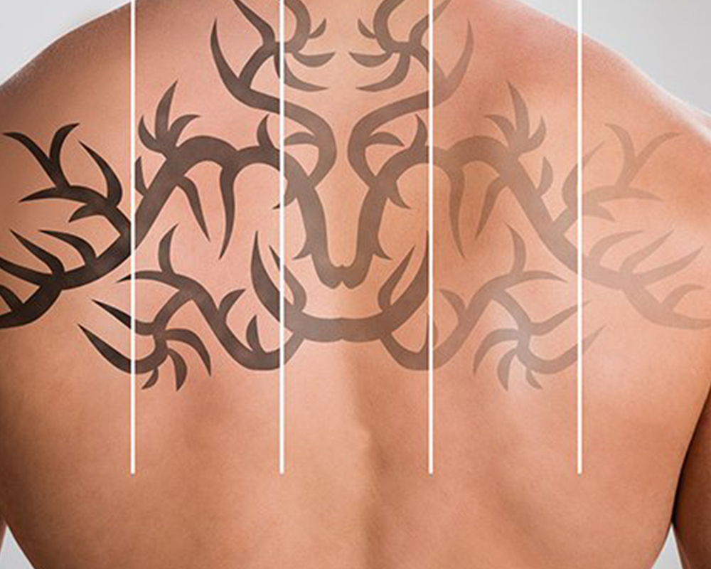 How does laser tattoo removal work  Goodbye Tattoos