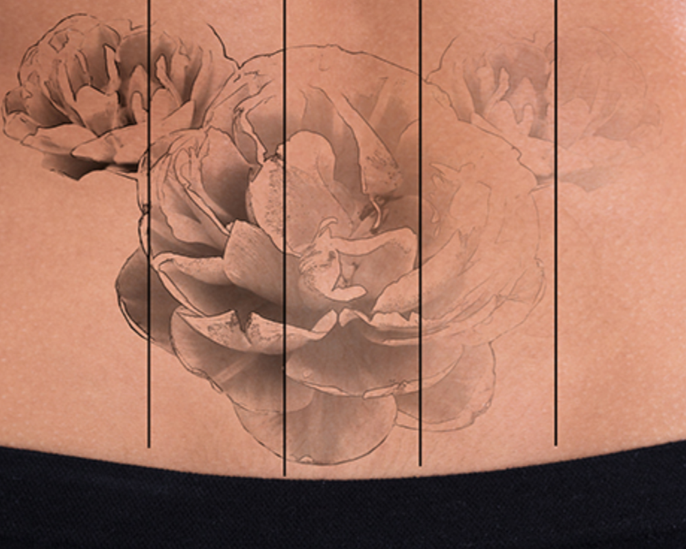 Top-Notch Q2 Cosmetic Laser: A Revolution In The Laser Tattoo