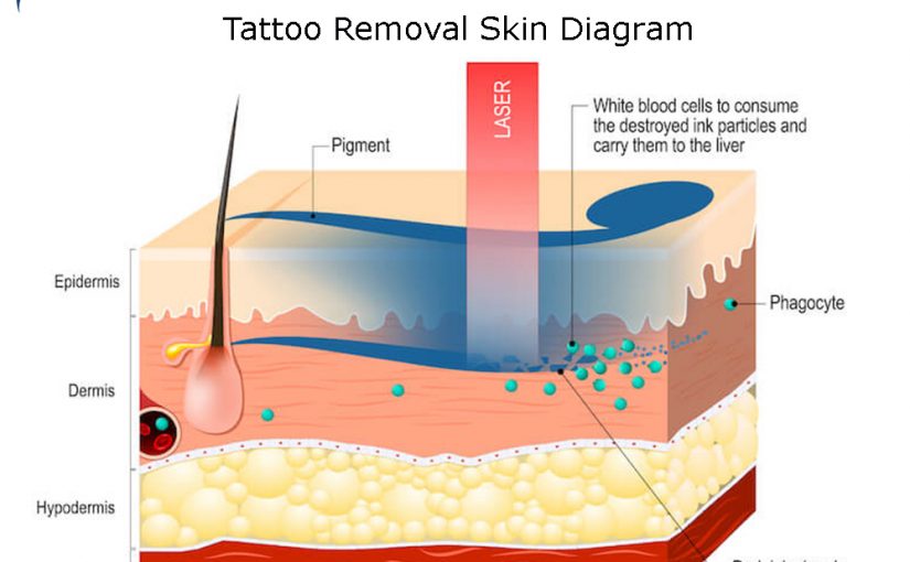 List of the Best Tattoo Removal Cosmetic Laser Machines
