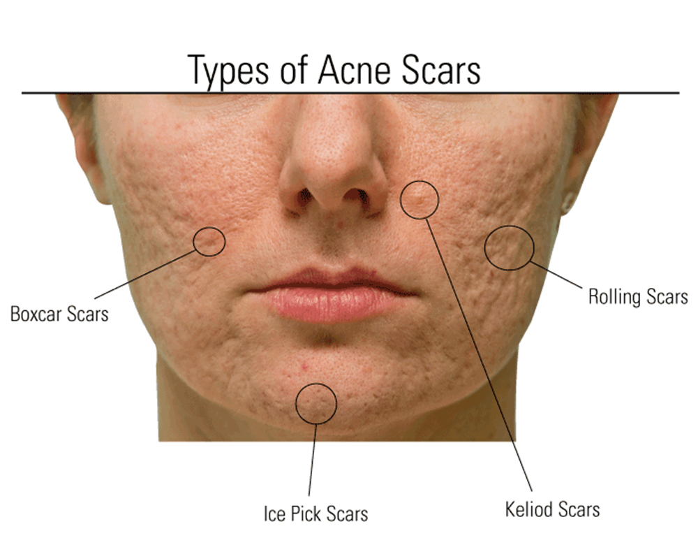Focus on Different Types of Acne Scars - MedLaserUSA