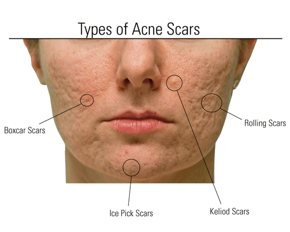 Focus On Different Types Of Acne Scars MedLaserUSA