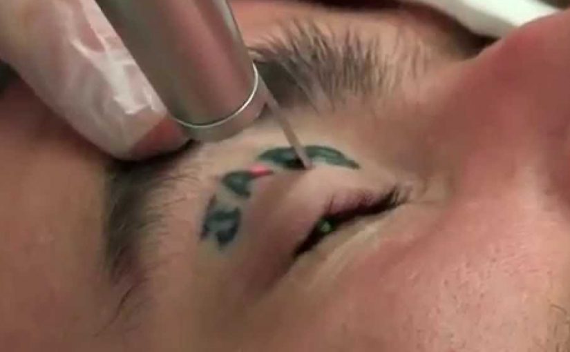 Picosecond Laser Tattoo Removal Technology