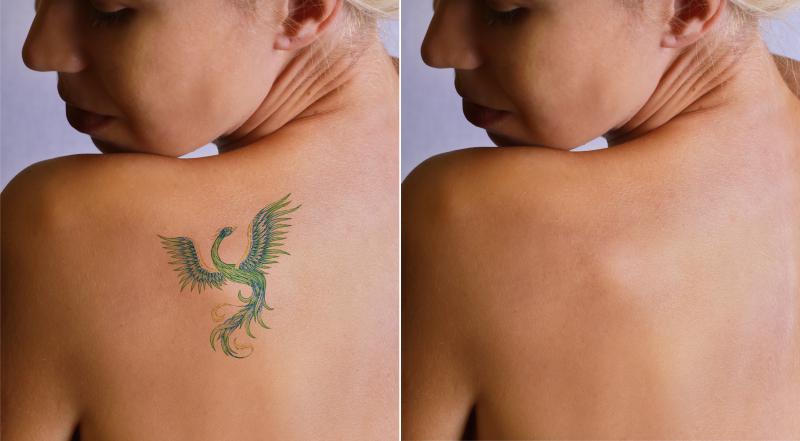 What You Need to Know about Recovery Post-Laser Tattoo Removal
