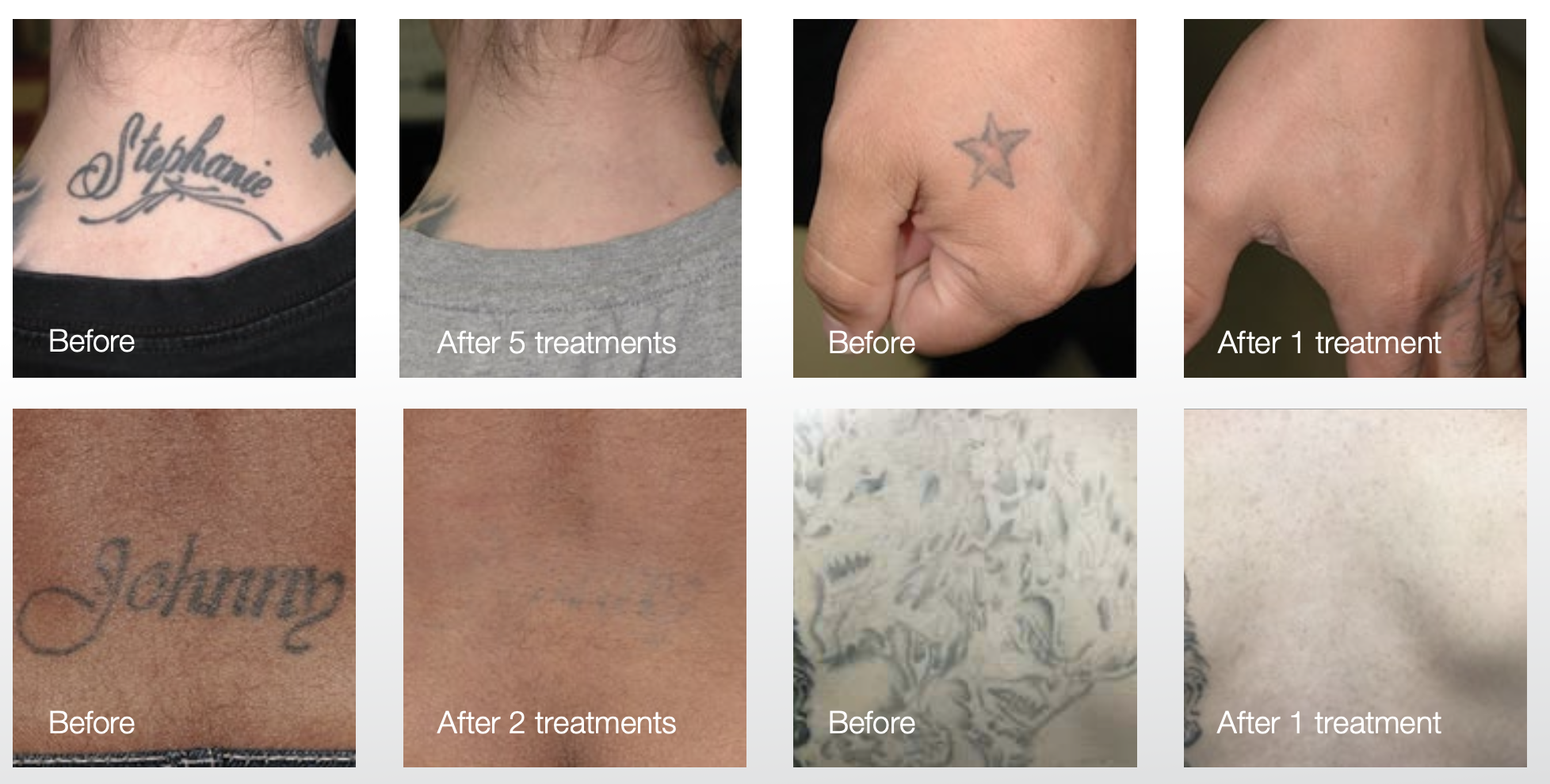 Lumenis PiQo4 for sale MedLaser USA before & after