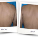 before and after soprano ice platinum 2