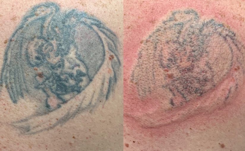 Tattoo Removal Machine Financing Made Easy