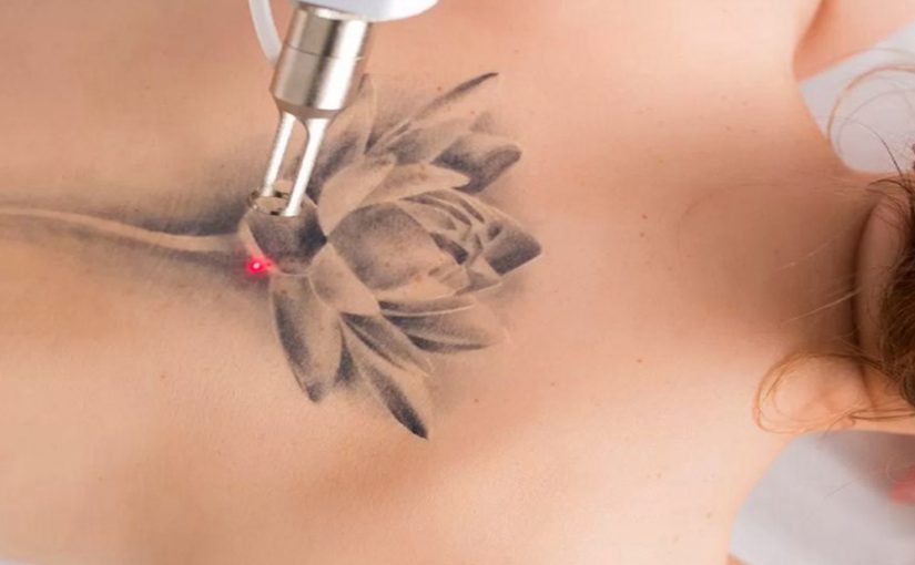 The Importance of Wavelengths in Tattoo Laser Removal